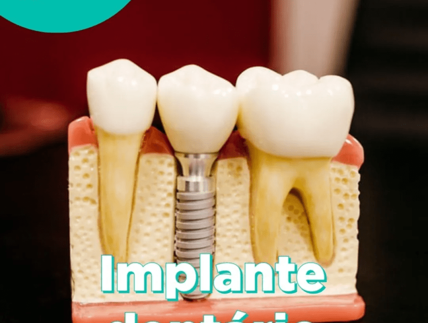 Implante Dentário