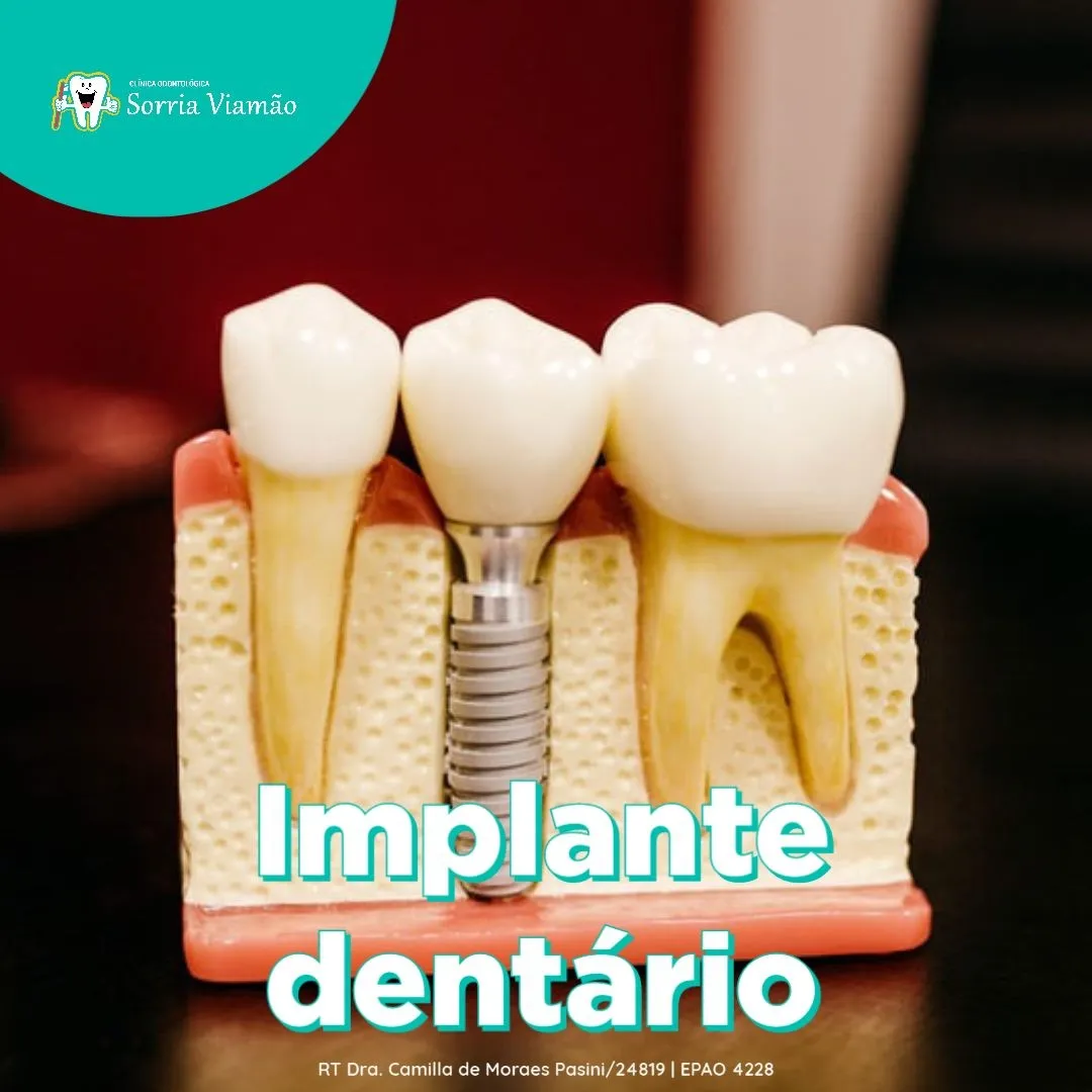 Implante Dentário