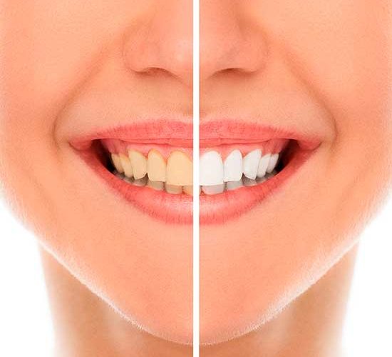 Clareamento Dentário