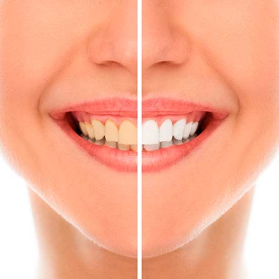 Clareamento Dentário